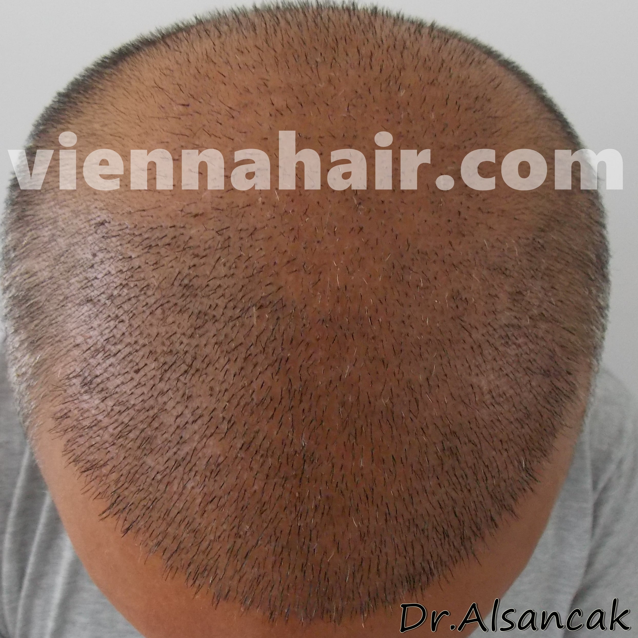 Before - After Archive | Hair Transplantation in Austria