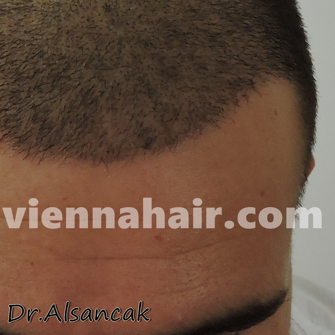 Before After Archive Hair Transplantation In Austria