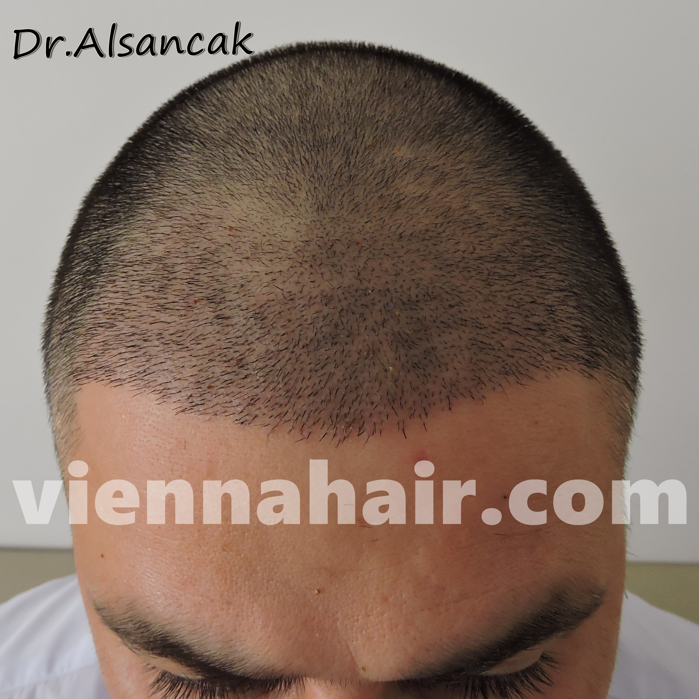 Before After Archive Hair Transplantation In Austria