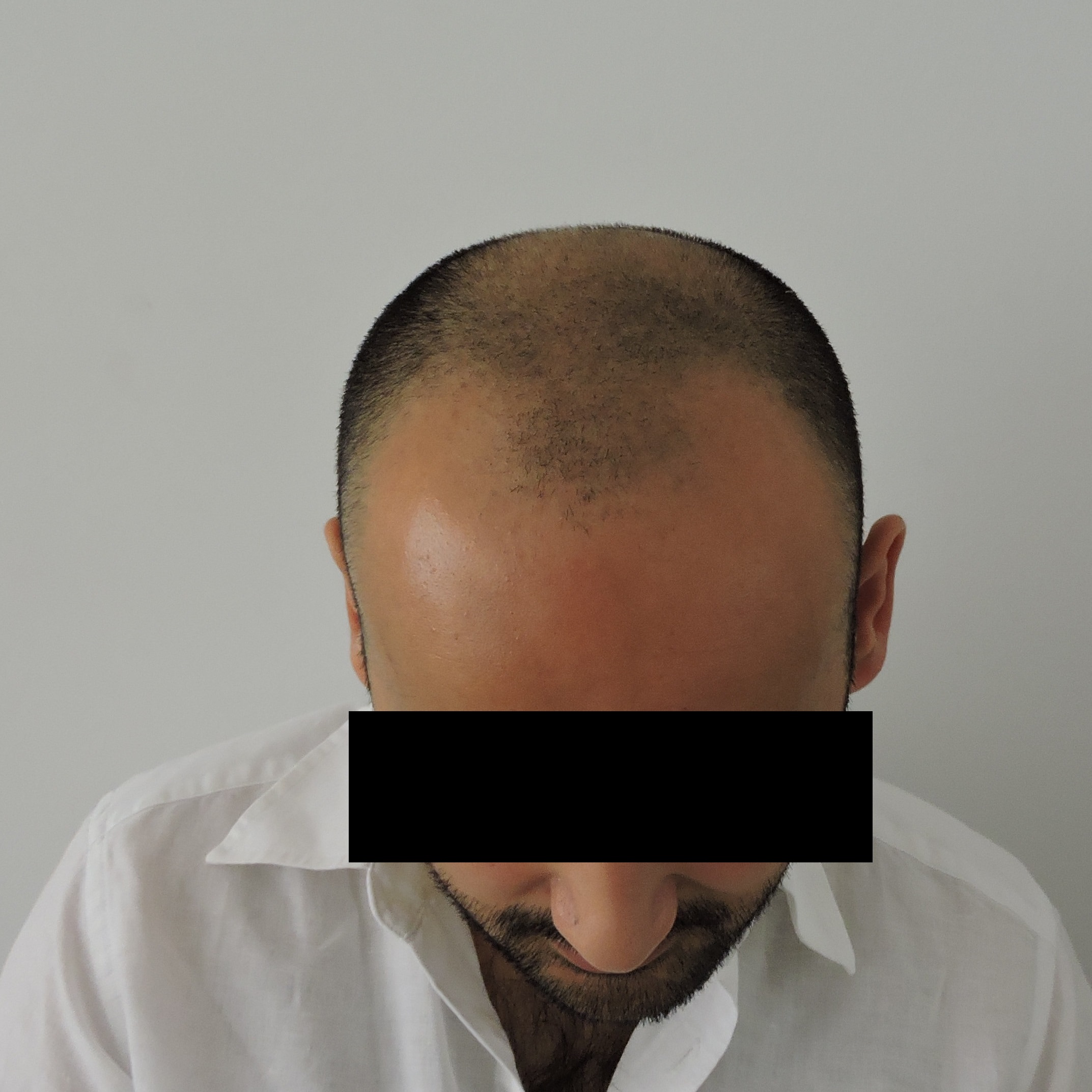 Before - After Archive | Hair Transplantation in Austria